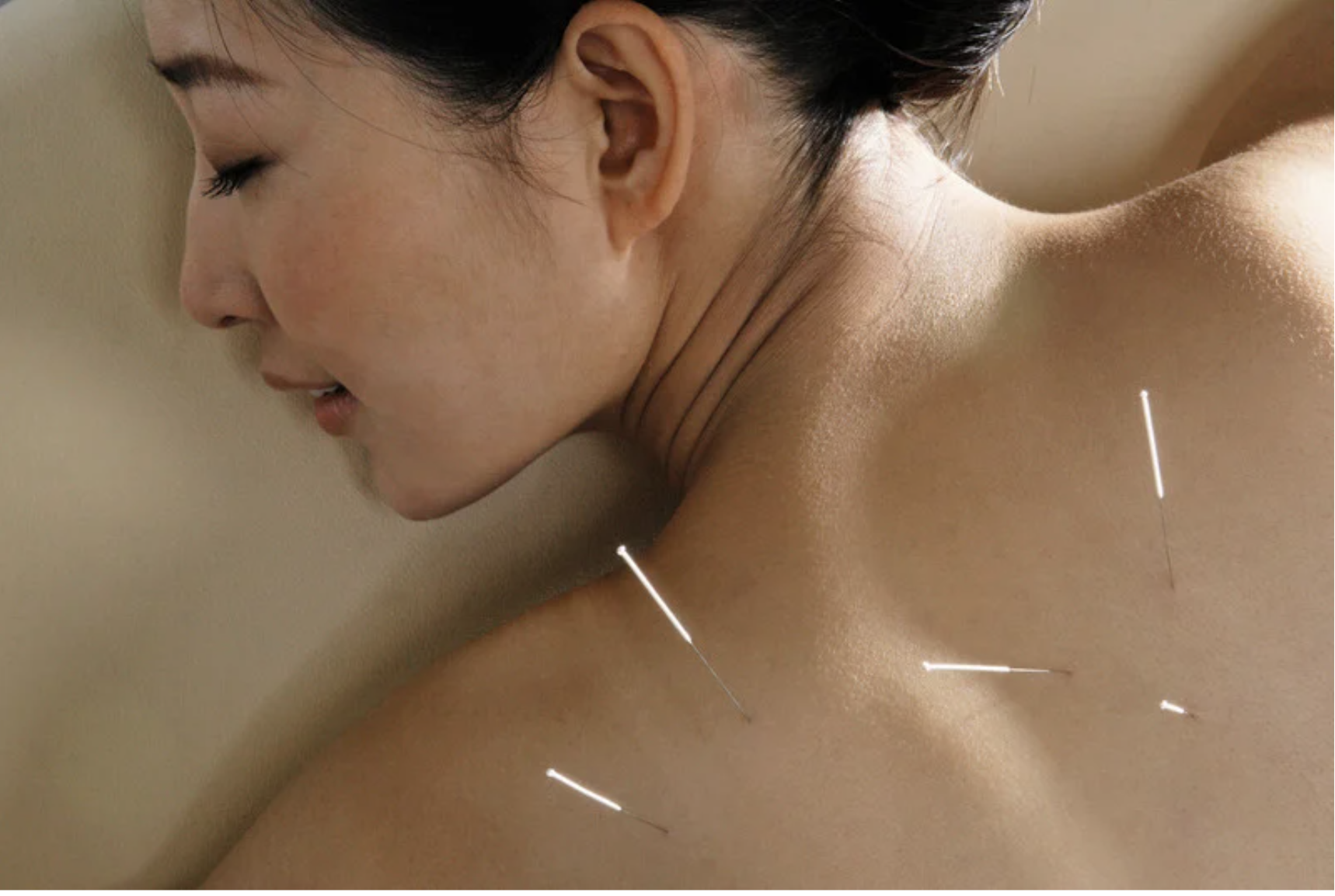 Acupuncture needles placed along the back — one of the most researched interventions for perimenopause symptoms